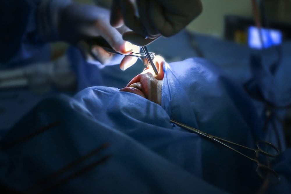 Rhinoplasty surgery